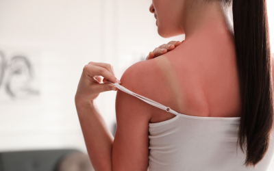 What to Do if You Get Sun Poisoning on Vacation